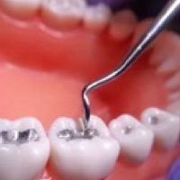 remocao-segura-de-amalgama